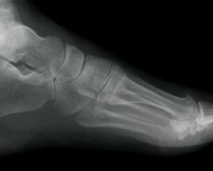 foot xray